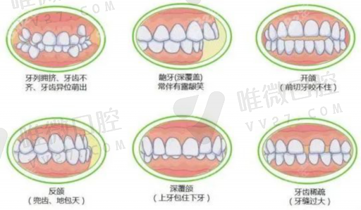 种植体螺丝固位和粘接固位（牙齿螺丝固位开孔位置）(图1)